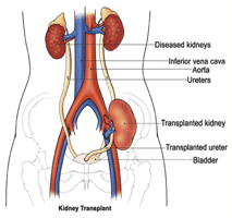 Kidney transplant anatomy